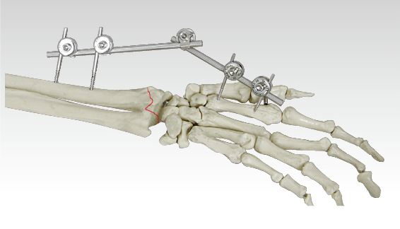 骨科手术器械